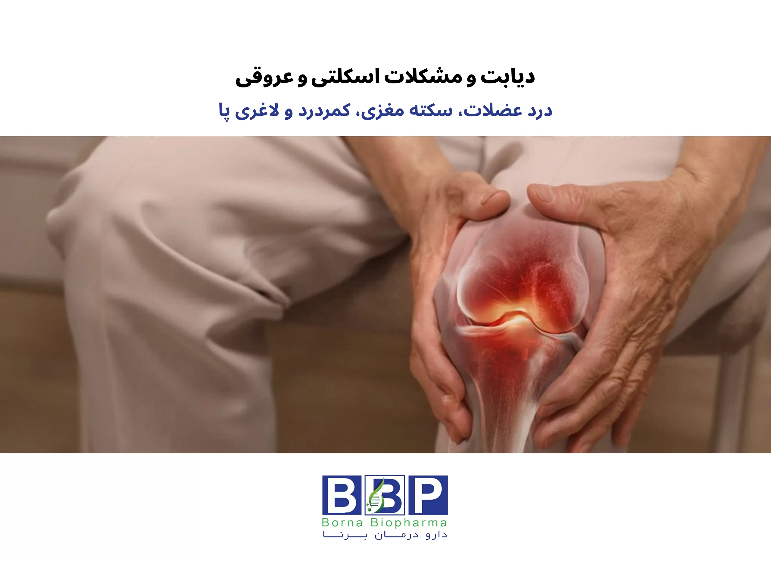 دیابت فقط قند خون نیست: مراقب عضلات، کمر، مغز و پاهای خود باشید بسیاری از افراد مبتلا به دیابت، تمام تمرکز خود را روی عدد قند خون می‌گذارند و غافل از اینکه این بیماری خاموش، آرام‌آرام به سایر قسمت‌های بدن نیز آسیب می‌زند. درد عضلات، کمردرد مزمن، خطر سکته مغزی و لاغری پاها، چهار عارضه مهمی هستند که در صورت بی‌توجهی، کیفیت زندگی را به شدت کاهش می‌دهند. در این راهنما، ساده و عملی با این عوارض آشنا می‌شوید. ۱. درد عضلات در دیابت: چرا و چه کنیم؟ چرا عضلات درد می‌گیرند؟ قند خون بالا به دو طریق به عضلات آسیب می‌زند: اول اینکه به اعصابی که عضلات را کنترل می‌کنند صدمه می‌زند (نوروپاتی)، دوم اینکه جریان خون را به عضلات کاهش می‌دهد. نتیجه: درد، گرفتگی، ضعف و خستگی زودرس. چه حسّی دارد؟ درد مبهم یا تیرکشنده در بازوها و پاها گرفتگی عضلات، مخصوصاً شب‌ها مورمور شدن یا احساس سوزش در پاها ضعف هنگام راه رفتن یا بلند شدن از صندلی چه کار کنیم؟ کنترل قند خون: مهم‌ترین قدم. قند متعادل = عضلات سالم‌تر. ورزش ملایم: پیاده‌روی، شنا، یوگا، تمرینات کششی. نیازی به ورزش سنگین نیست. مکمل‌ها: با نظر پزشک، ویتامین D، B12 و منیزیم می‌توانند کمک کنند. ماساژ و فیزیوتراپی: برای کاهش سفتی و گرفتگی. آب کافی بنوشید: کم‌آبی گرفتگی را بدتر می‌کند. ۲. دیابت و سکته مغزی: خطری که نباید نادیده بگیرید چرا دیابتی‌ها بیشتر سکته می‌کنند؟ قند بالا رگ‌های خونی را شکننده و چسبناک می‌کند. چربی و کلسترول به دیواره رگ‌ها می‌چسبد (تصلب شرایین)، رگ تنگ می‌شود و ممکن است لخته خون مسیر رسیدن خون به مغز را مسدود کند. علائم هشداردهنده (هر یک از اینها را جدی بگیرید): ضعف یا بی‌حسی ناگهانی در یک طرف صورت یا بدن اختلال در صحبت کردن یا فهمیدن حرف دیگران سردرد شدید و بی‌سابقه تاری دید یا دوبینی سرگیجه و از دست دادن تعادل اگر این علائم را دیدید، فوراً اورژانس بگیرید. هر دقیقه تأخیر = آسیب بیشتر به مغز. پیشگیری از سکته در دیابت: قند خون را در محدوده هدف نگه دارید فشار خون را کنترل کنید (کمتر از ۱۳۰/۸۰) کلسترول را پایین بیاورید (با رژیم و در صورت نیاز دارو) اگر سیگار می‌کشید، ترک کنید روزی ۳۰ دقیقه پیاده‌روی کنید ۳. دیابت و کمردرد: ارتباط پنهان آیا می‌دانستید دیابت می‌تواند باعث کمردرد شود؟ قند خون بالا باعث التهاب مزمن در بدن می‌شود. این التهاب به دیسک‌های بین مهره‌های کمر آسیب می‌زند و آنها را زودتر از موعد فرسوده می‌کند. همچنین اعصابی که به ستون فقرات خدمات می‌دهند، در اثر دیابت آسیب می‌بینند. راهکارهای کاهش کمردرد: قند خون را کنترل کنید (پایه همه چیز) ورزش‌های مخصوص کمر: تمرینات کششی و تقویت عضلات شکم و پشت رژیم ضدالتهاب: ماهی، مغزها، سبزیجات، روغن زیتون – دور قندهای ساده خط بکشید فیزیوتراپی و ماساژ موقع نشستن و خوابیدن، وضعیت بدن را درست نگه دارید ۴. لاغری پا در دیابت: چرا پاها نازک می‌شوند؟ علت: دو عامل اصلی: اول، نوروپاتی دیابتی که باعث تحلیل عضلات پا می‌شود. دوم، کاهش جریان خون که مواد مغذی را به عضلات پا نمی‌رساند. نتیجه: پاها ضعیف، نازک و گاهی دردناک می‌شوند. همچنین خطر زخم پا و عفونت افزایش می‌یابد. چه باید کرد؟ ورزش‌های مقاومتی سبک برای پاها (بلند کردن انگشتان پا، راه رفتن روی پنجه) کنترل قند خون معاینه روزانه پاها برای پیدا کردن زخم‌های کوچک استفاده از کرم‌های ترمیم‌کننده (مثل کرم برنامین دارای EGF و سیلور سولفادیازین) در صورت وجود زخم کفش مناسب بپوشید تا از فشار روی پا جلوگیری شود خلاصه طلایی برای بیماران دیابتی عارضه مهم‌ترین اقدام پیشگیرانه درد عضلات ورزش منظم + کنترل قند سکته مغزی کنترل فشار خون و قند + ترک سیگار کمردرد تمرینات کششی + رژیم ضدالتهاب لاغری پا معاینه روزانه پا + ورزش مقاومتی سبک حرف آخر: دیابت یک بیماری همه‌جانبه است. اگر فقط به قند خون فکر کنید، بقیه قسمت‌های بدن فراموش می‌شوند. عضلات، کمر، مغز و پاهای شما نیز به مراقبت نیاز دارند. با کنترل قند، ورزش روزانه، تغذیه سالم و چکاپ‌های منظم، می‌توانید این عوارض را به تأخیر بیندازید یا حتی از آنها پیشگیری کنید.